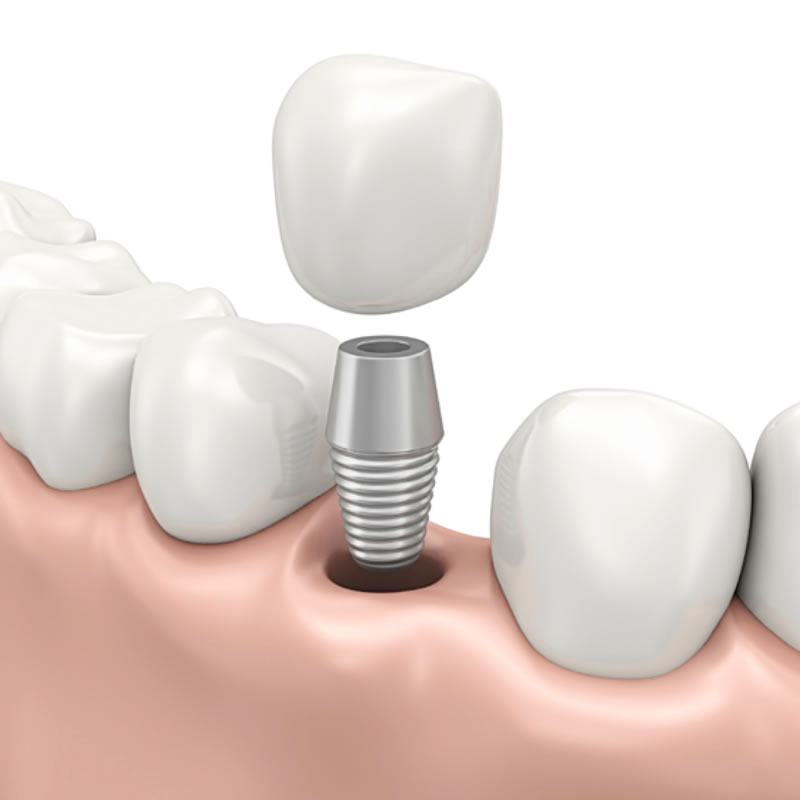 Dental Implants Brampton